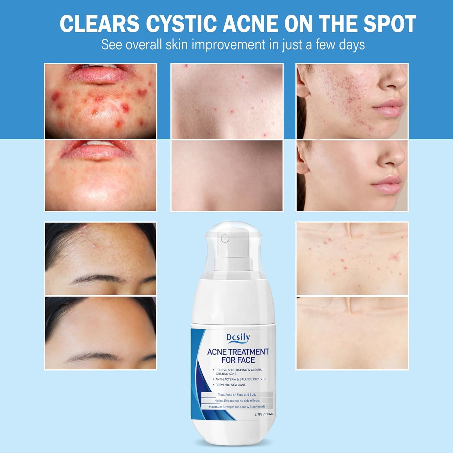 DCsily Acne Treatment for face